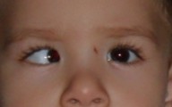 Infantile esotropia clinical photograph