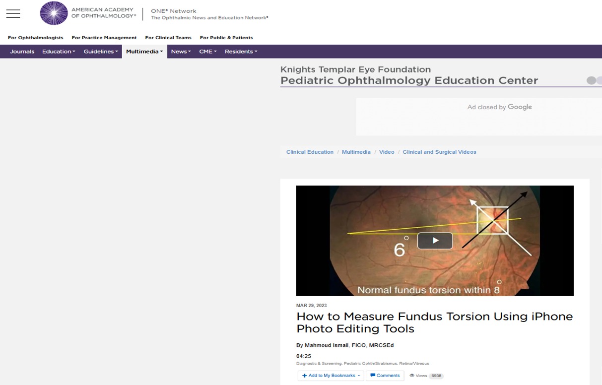 How to Measure Fundus Torsion Using iPhone Photo Editing Tools
